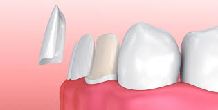 FAQs About Dental Veneers