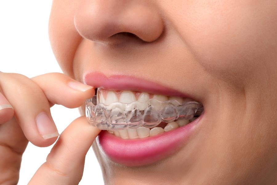 The Benefits of Invisalign for Teens and Adults