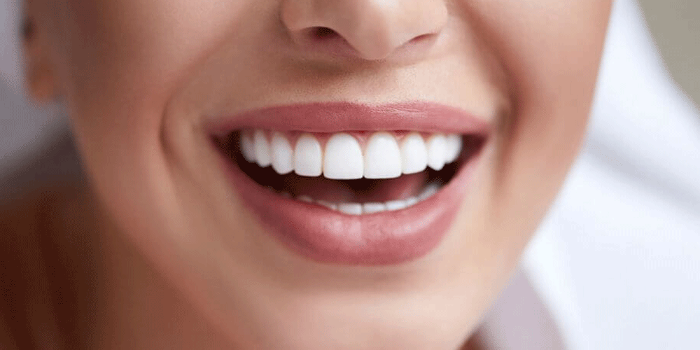 The Benefits of Veneers for a Hollywood Smile