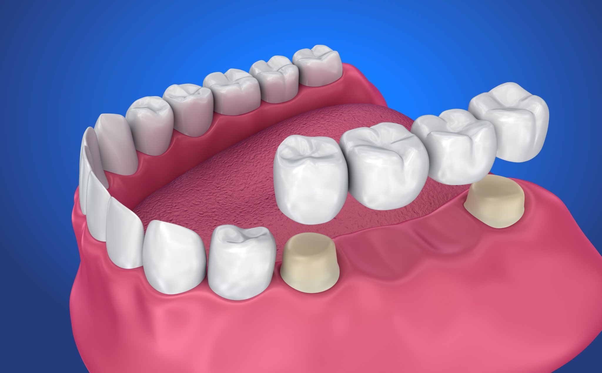 Types of Dental Crowns and Bridges