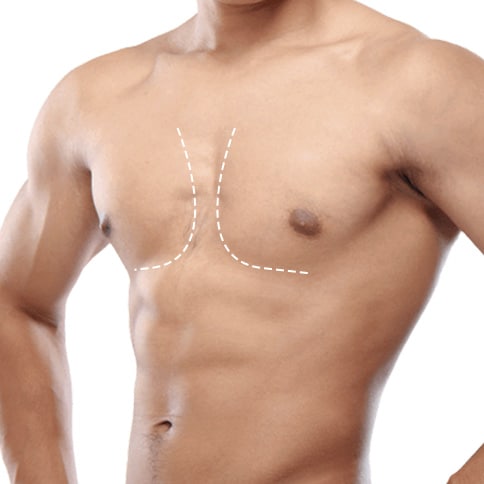Discovering Confidence: A Simple Guide to Gynecomastia in Dubai